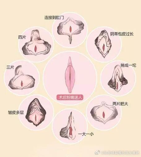 探讨女人私密肥大：原因与解决方案